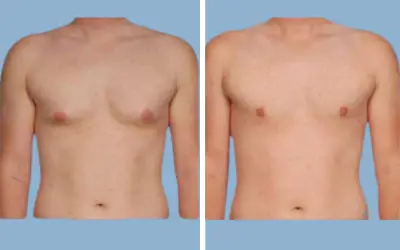 Gynecomastia surgery before and after result 9 - male breast reduction in India, IndiCure patient
