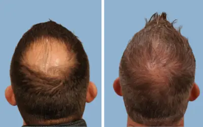Hair transplant before and after result 1 - performed in India, IndiCure patient