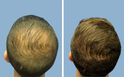 Hair transplant before and after result 10 - performed in India, IndiCure patient