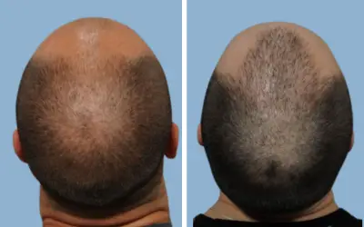 Hair transplant before and after result 2 - performed in India, IndiCure patient