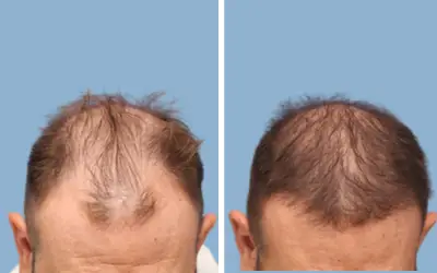Hair transplant before and after result 3 - performed in India, IndiCure patient