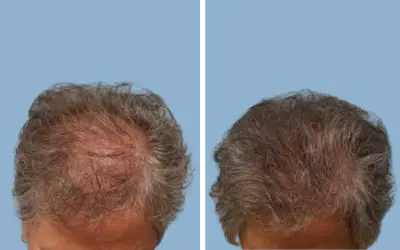Hair transplant before and after result 5 - performed in India, IndiCure patient