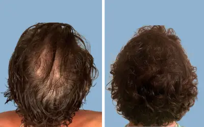 Hair transplant before and after result 6 - performed in India, IndiCure patient