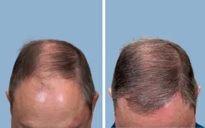 Hair transplant before and after result 8 - performed in India, IndiCure patient