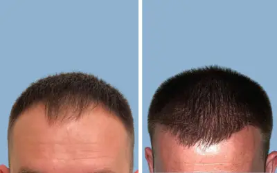 Hair transplant before and after result 9 - performed in India, IndiCure patient