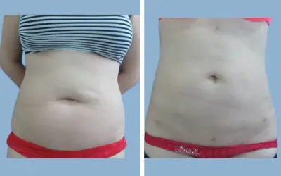 Liposuction before and after result 1 - body contouring in India, IndiCure patient