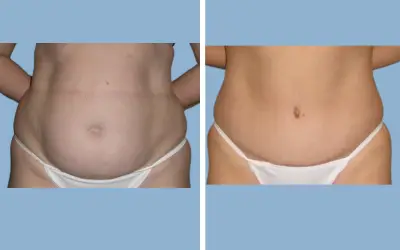 Liposuction before and after result 10 - body contouring in India, IndiCure patient