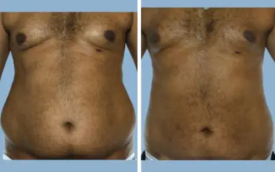 Liposuction before and after result 11 - body contouring in India, IndiCure patient