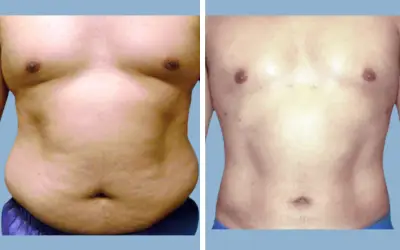 Liposuction before and after result 12 - body contouring in India, IndiCure patient
