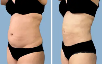 Liposuction before and after result 13 - body contouring in India, IndiCure patient