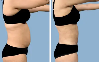 Liposuction before and after result 14 - body contouring in India, IndiCure patient