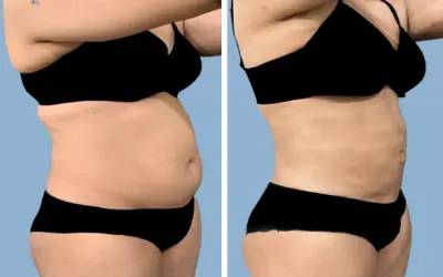 Liposuction before and after result 15 - body contouring in India, IndiCure patient