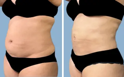 Liposuction before and after result 16 - body contouring in India, IndiCure patient