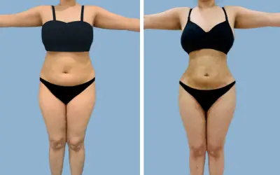 Liposuction before and after result 17 - body contouring in India, IndiCure patient