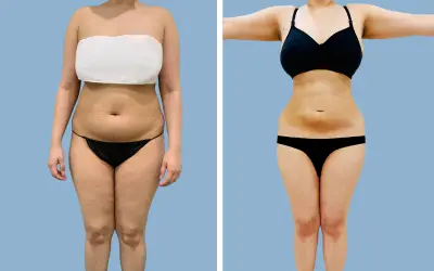 Liposuction before and after result 18 - body contouring in India, IndiCure patient