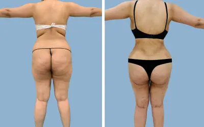 Liposuction before and after result 19 - body contouring in India, IndiCure patient