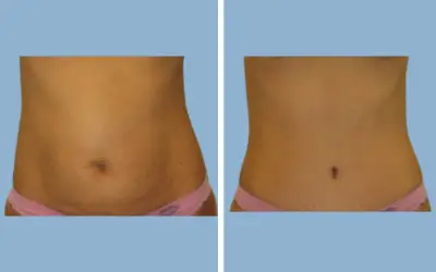 Liposuction before and after result 2 - body contouring in India, IndiCure patient