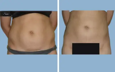 Liposuction before and after result 3 - body contouring in India, IndiCure patient