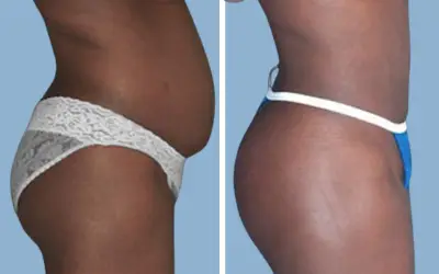 Liposuction before and after result 4 - body contouring in India, IndiCure patient