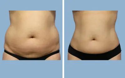 Liposuction before and after result 6 - body contouring in India, IndiCure patient
