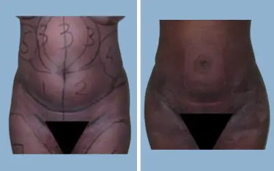 Liposuction before and after result 7 - body contouring in India, IndiCure patient