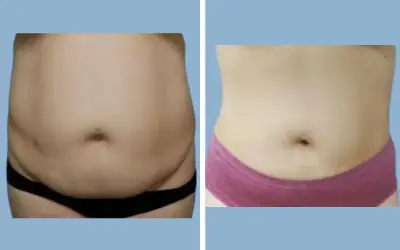 Liposuction before and after result 8 - body contouring in India, IndiCure patient