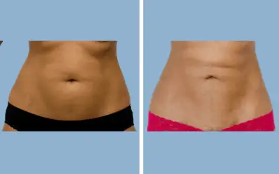 Liposuction before and after result 9 - body contouring in India, IndiCure patient