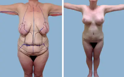 Mommy makeover before and after result 1 - performed in India, IndiCure patient
