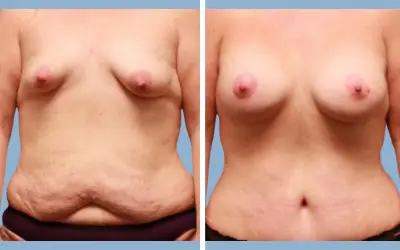 Mommy makeover before and after result 10 - performed in India, IndiCure patient