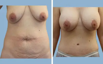 Mommy makeover before and after result 11 - performed in India, IndiCure patient