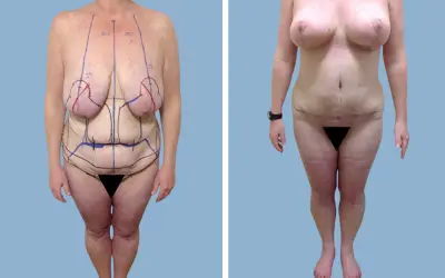 Mommy makeover before and after result 2 - performed in India, IndiCure patient