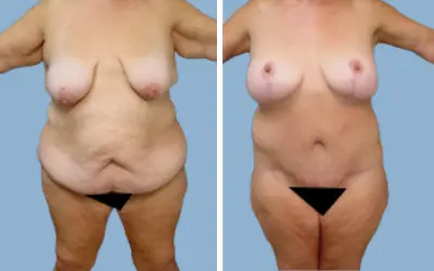Mommy makeover before and after result 3 - performed in India, IndiCure patient