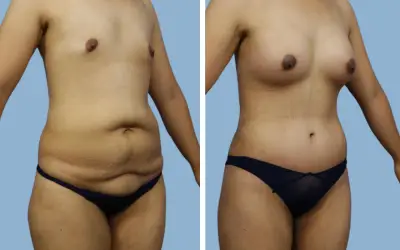 Mommy makeover before and after result 5 - performed in India, IndiCure patient