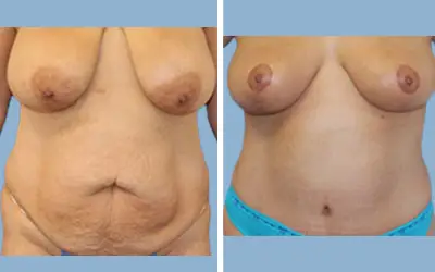 Mommy makeover before and after result 6 - performed in India, IndiCure patient