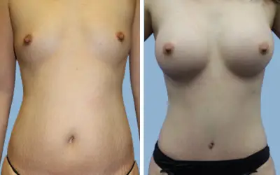 Mommy makeover before and after result 7 - performed in India, IndiCure patient