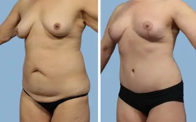 Mommy makeover before and after result 8 - performed in India, IndiCure patient