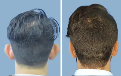 Otoplasty before and after result 1 - ear reshaping surgery in India, IndiCure patient