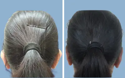 Otoplasty before and after result 2 - ear reshaping surgery in India, IndiCure patient