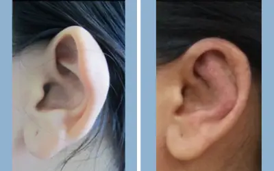 Otoplasty before and after result 3 - ear reshaping surgery in India, IndiCure patient
