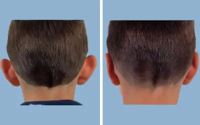 Otoplasty before and after result 4 - ear reshaping surgery in India, IndiCure patient