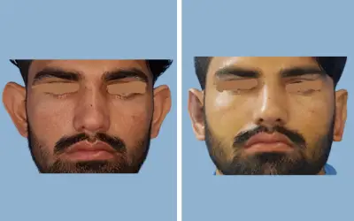 Otoplasty before and after result 5 - ear reshaping surgery in India, IndiCure patient