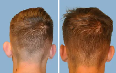 Otoplasty before and after result 6 - ear reshaping surgery in India, IndiCure patient