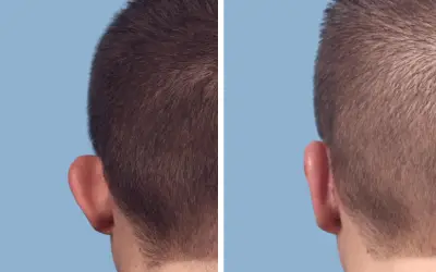 Otoplasty before and after result 7 - ear reshaping surgery in India, IndiCure patient