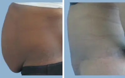 Tummy tuck before and after result 10 - abdominoplasty performed in India, IndiCure patient