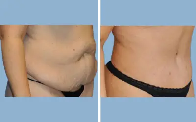 Tummy tuck before and after result 11 - abdominoplasty performed in India, IndiCure patient