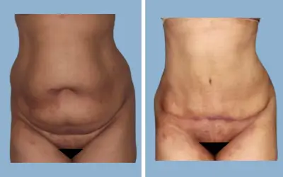 Tummy tuck before and after result 12 - abdominoplasty performed in India, IndiCure patient