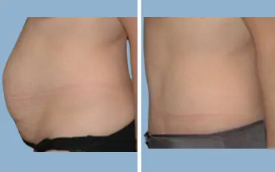 Tummy tuck before and after result 13 - abdominoplasty performed in India, IndiCure patient
