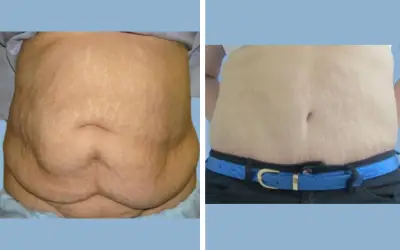 Tummy tuck before and after result 14 - abdominoplasty performed in India, IndiCure patient