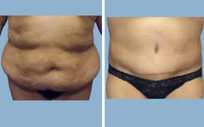 Tummy tuck before and after result 15 - abdominoplasty performed in India, IndiCure patient