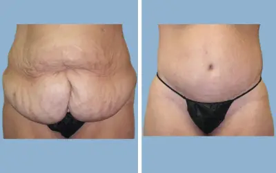 Tummy tuck before and after result 16 - abdominoplasty performed in India, IndiCure patient